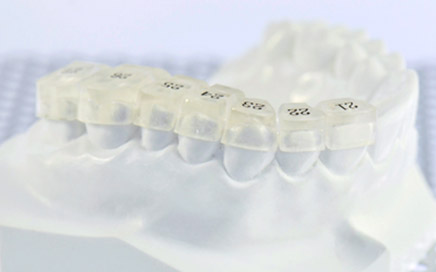 リボンディングに使用可能な個歯タイプのインダイレクトボンディングコア